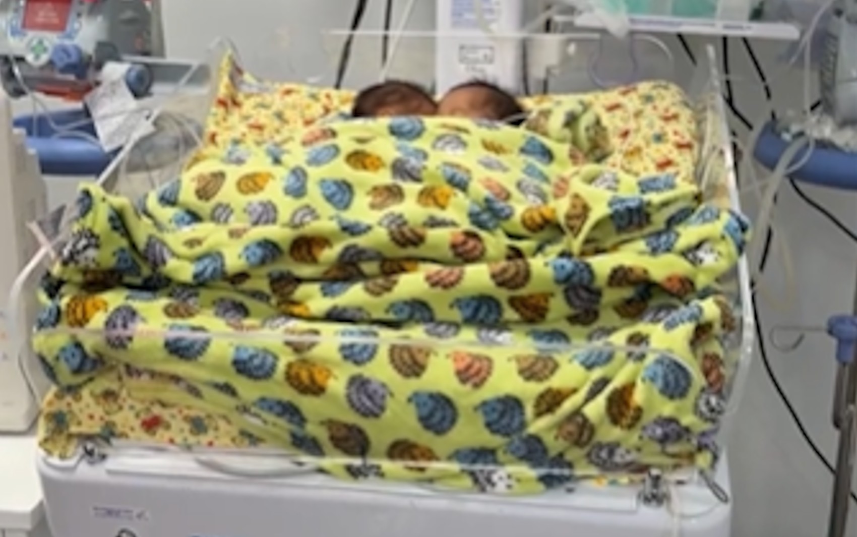 Bebês siameses que nasceram unidos pelo abdômen morrem em Goiânia bebes-siameses-que-nasceram-unidos-pelo-abdomen-morrem-em-goiania