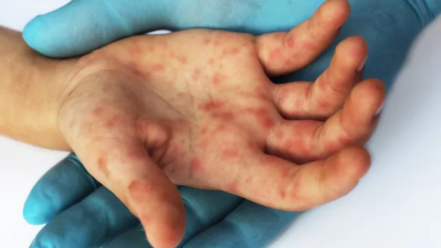 Quão perigoso é o sarampo? Sintomas para ficar de olho e como se proteger quao-perigoso-e-o-sarampo?-sintomas-para-ficar-de-olho-e-como-se-proteger